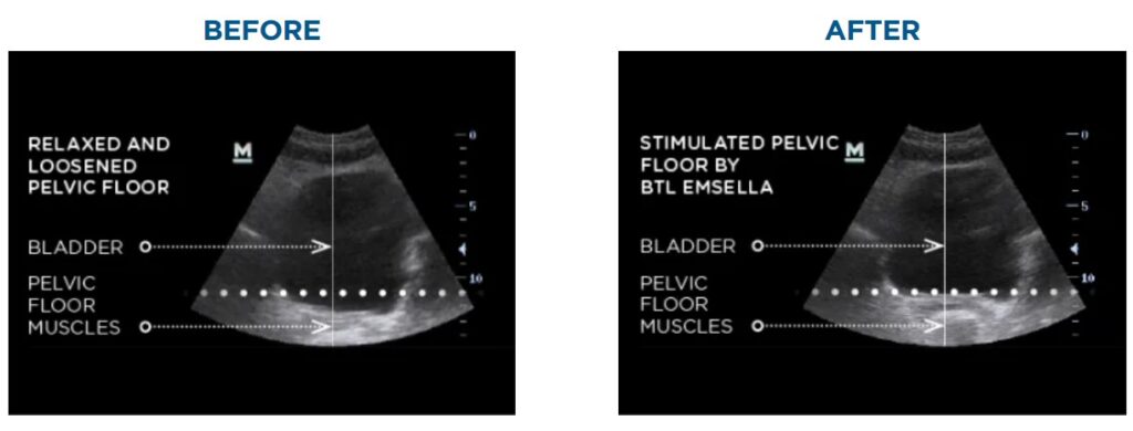 emsella before after