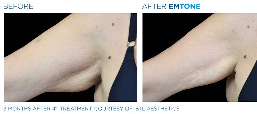 before and after emtone for abs