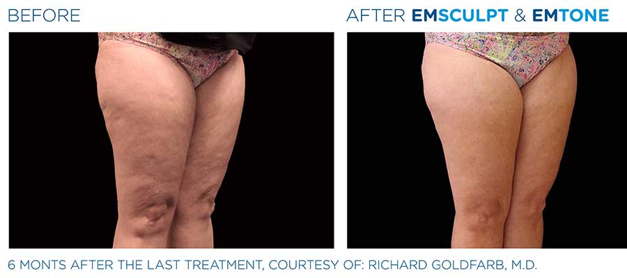 before and after emsculpt & emtone for legs