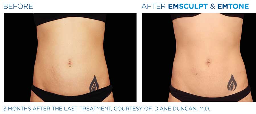 before and after emsculpt & emtone for abs