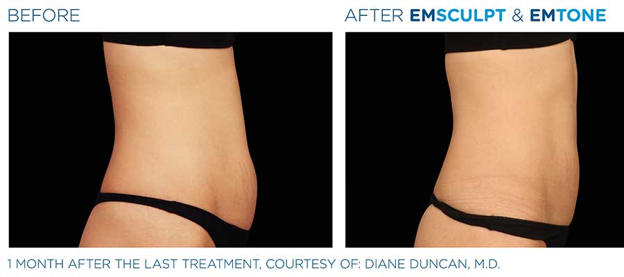 before and after emsculpt & emtone for abs