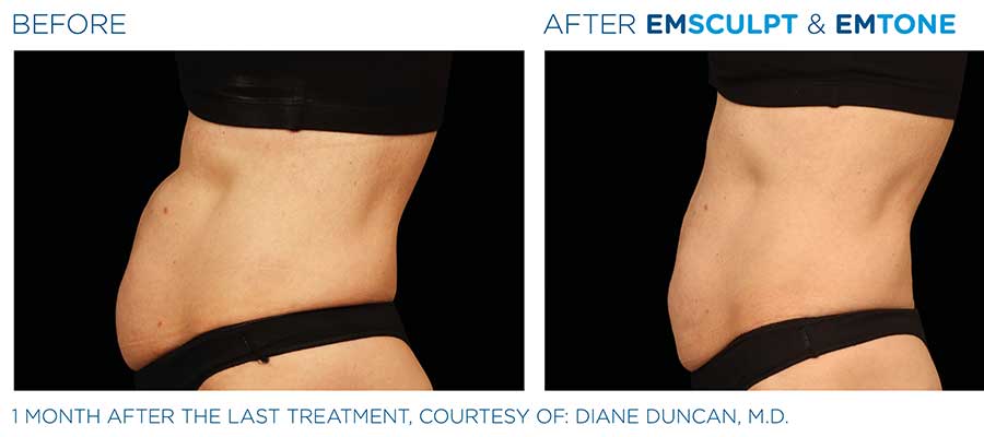 before and after emsculpt & emtone for abs