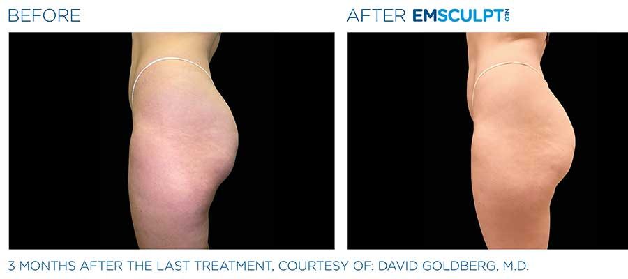 before and after emsculpt for butt