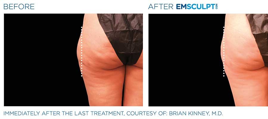 before and after emsculpt for legs